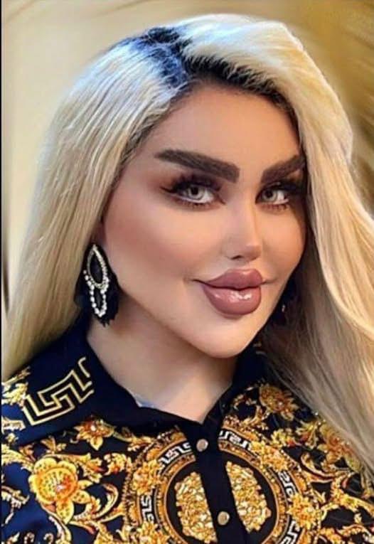 She Had 43 Cosmetic Procedures To Become A Barbie Doll